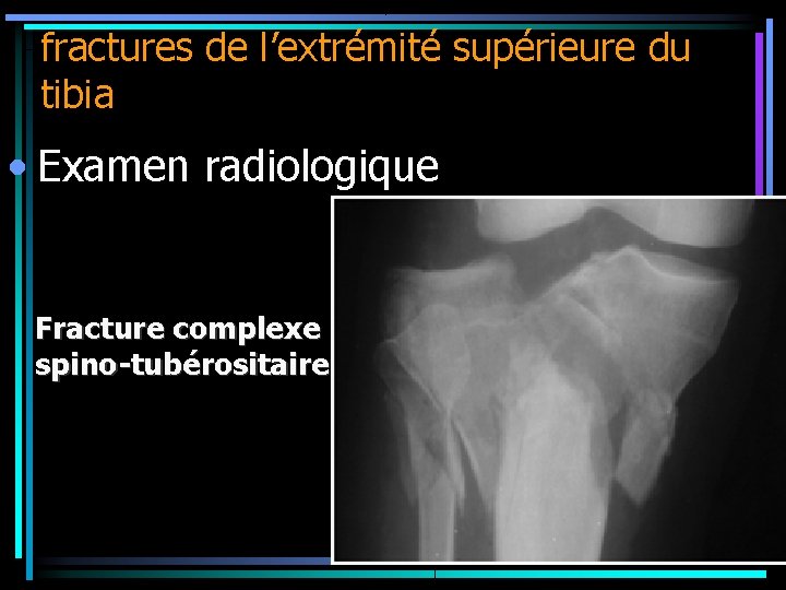 fractures de l’extrémité supérieure du tibia • Examen radiologique Fracture complexe spino-tubérositaire 