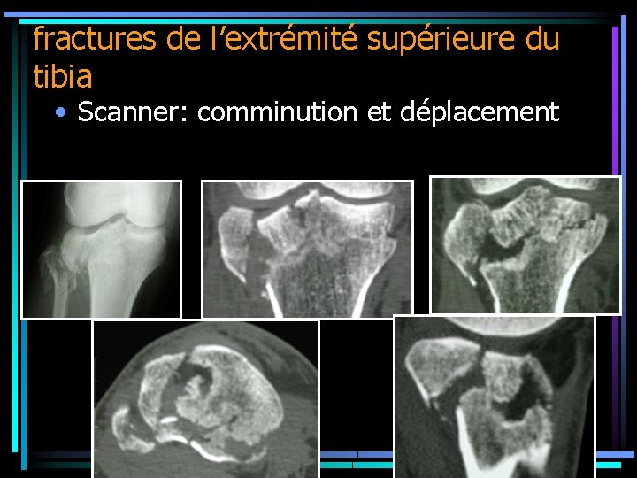 fractures de l’extrémité supérieure du tibia • Scanner: comminution et déplacement 