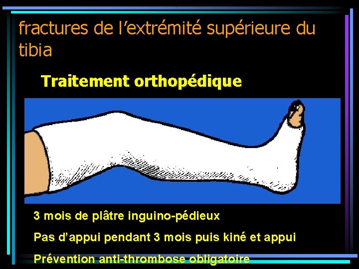 fractures de l’extrémité supérieure du tibia Traitement orthopédique 3 mois de plâtre inguino-pédieux Pas