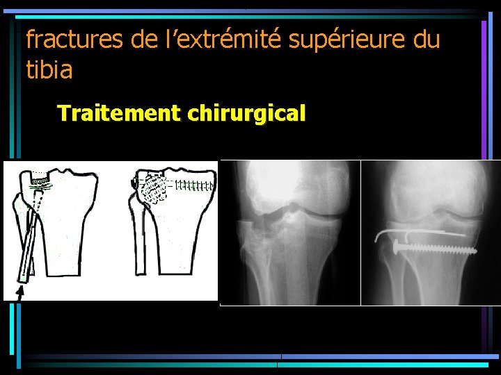 fractures de l’extrémité supérieure du tibia Traitement chirurgical 