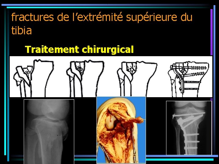 fractures de l’extrémité supérieure du tibia Traitement chirurgical 