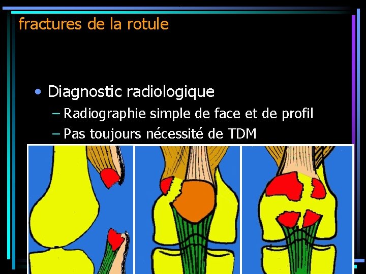 fractures de la rotule • Diagnostic radiologique – Radiographie simple de face et de