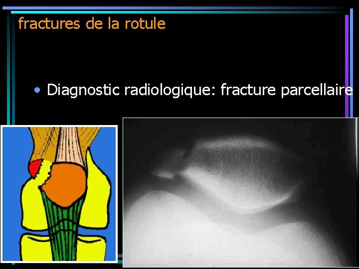 fractures de la rotule • Diagnostic radiologique: fracture parcellaire 