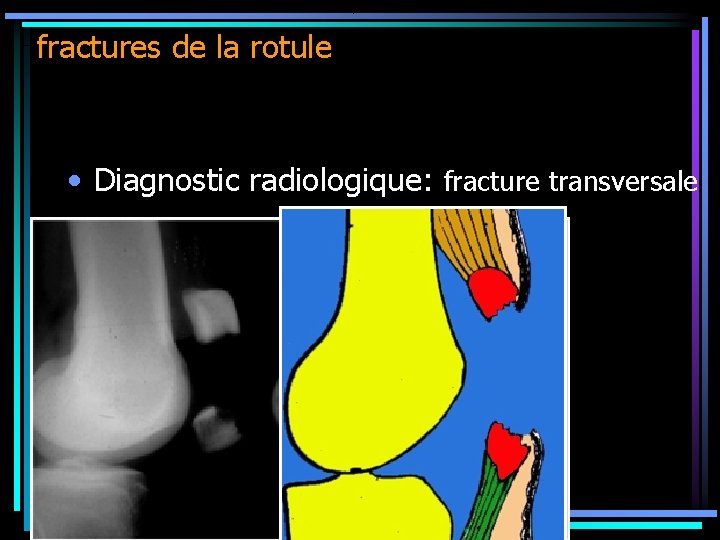 fractures de la rotule • Diagnostic radiologique: fracture transversale 