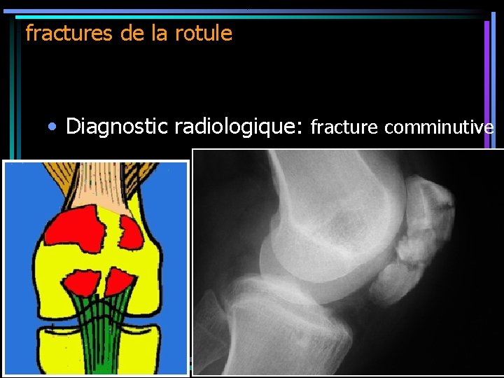 fractures de la rotule • Diagnostic radiologique: fracture comminutive 