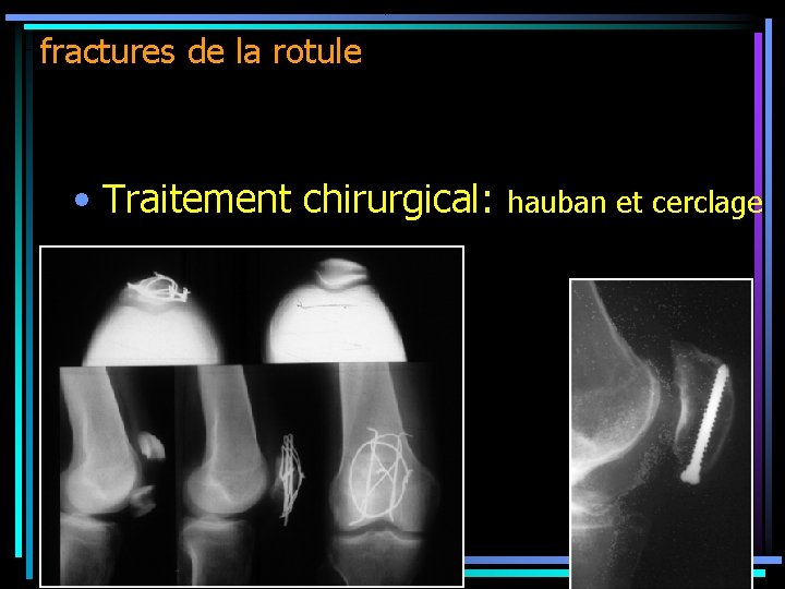 fractures de la rotule • Traitement chirurgical: hauban et cerclage 