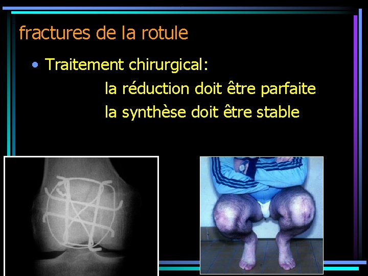 fractures de la rotule • Traitement chirurgical: la réduction doit être parfaite la synthèse