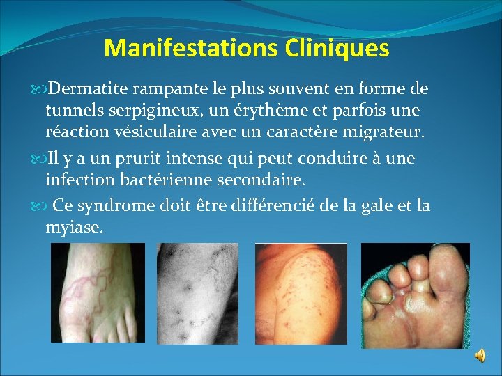 Manifestations Cliniques Dermatite rampante le plus souvent en forme de tunnels serpigineux, un érythème