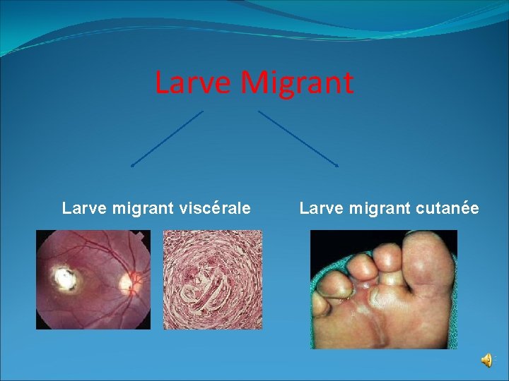 Larve Migrant Larve migrant viscérale Larve migrant cutanée 