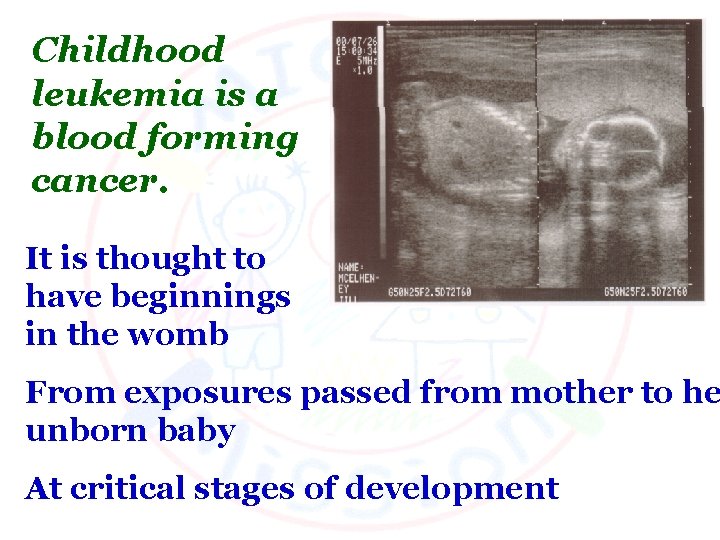 Childhood leukemia is a blood forming cancer. It is thought to have beginnings in