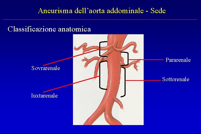 Aneurisma dell’aorta addominale - Sede Classificazione anatomica Pararenale Sovrarenale Sottorenale Iuxtarenale 