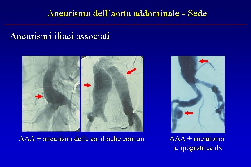 Aneurisma dell’aorta addominale - Sede Aneurismi iliaci associati AAA + aneurismi delle aa. iliache