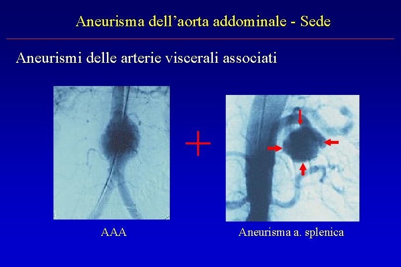 Aneurisma dell’aorta addominale - Sede Aneurismi delle arterie viscerali associati + AAA Aneurisma a.