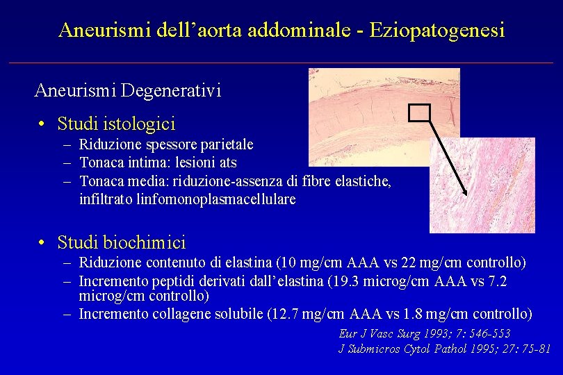 Aneurismi dell’aorta addominale - Eziopatogenesi Aneurismi Degenerativi • Studi istologici – Riduzione spessore parietale