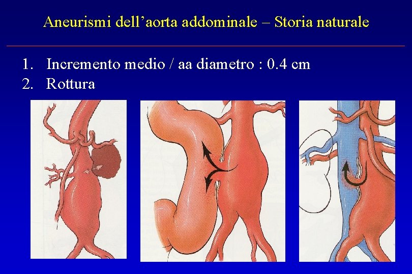 Aneurismi dell’aorta addominale – Storia naturale 1. Incremento medio / aa diametro : 0.