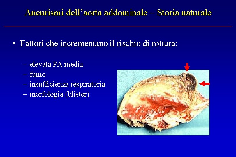 Aneurismi dell’aorta addominale – Storia naturale • Fattori che incrementano il rischio di rottura: