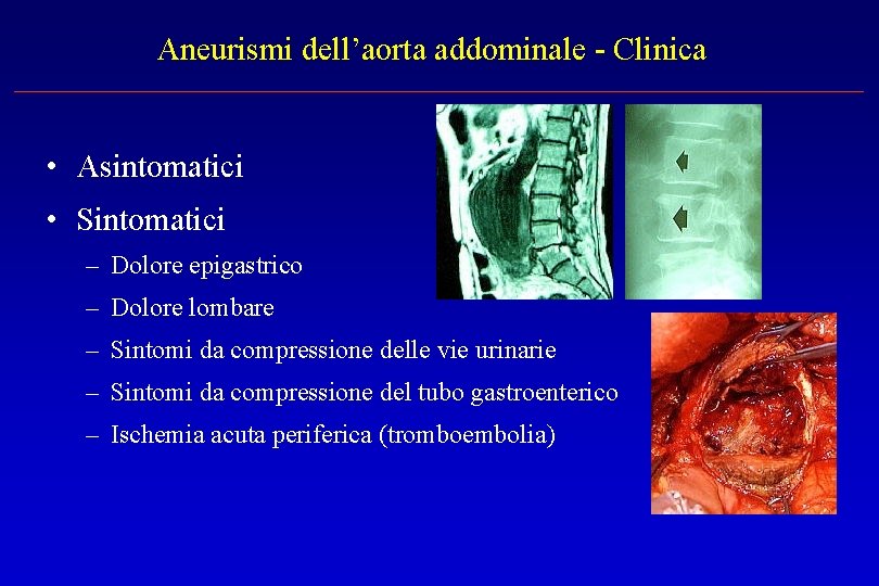 Aneurismi dell’aorta addominale - Clinica • Asintomatici • Sintomatici – Dolore epigastrico – Dolore