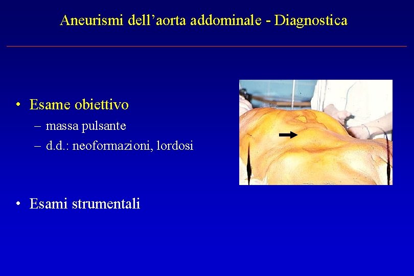 Aneurismi dell’aorta addominale - Diagnostica • Esame obiettivo – massa pulsante – d. d.