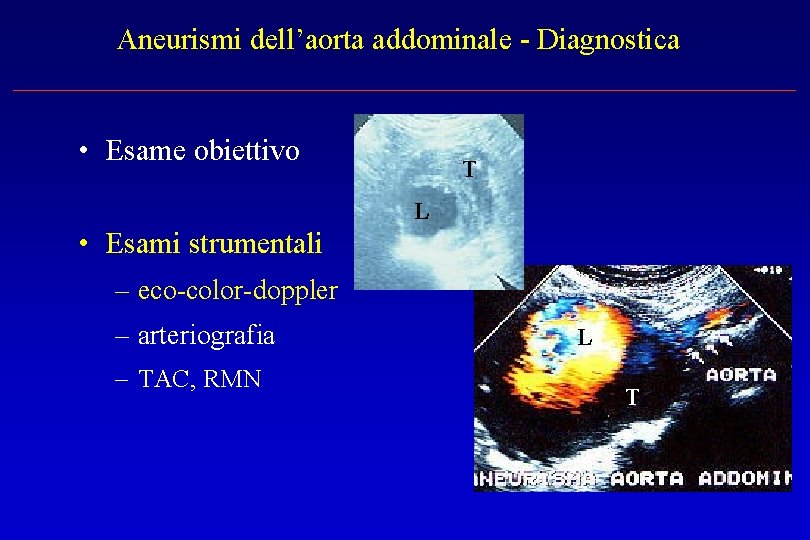 Aneurismi dell’aorta addominale - Diagnostica • Esame obiettivo T L • Esami strumentali –