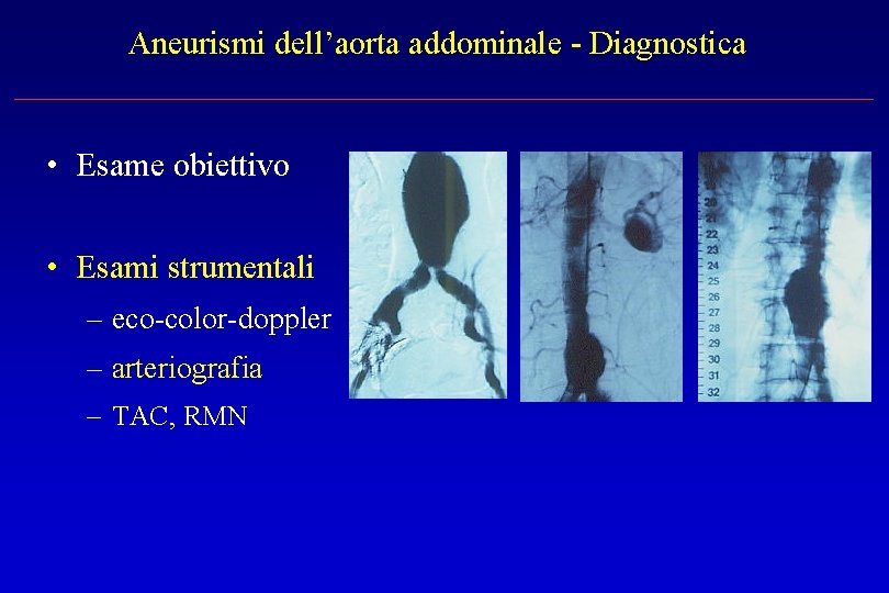Aneurismi dell’aorta addominale - Diagnostica • Esame obiettivo • Esami strumentali – eco-color-doppler –