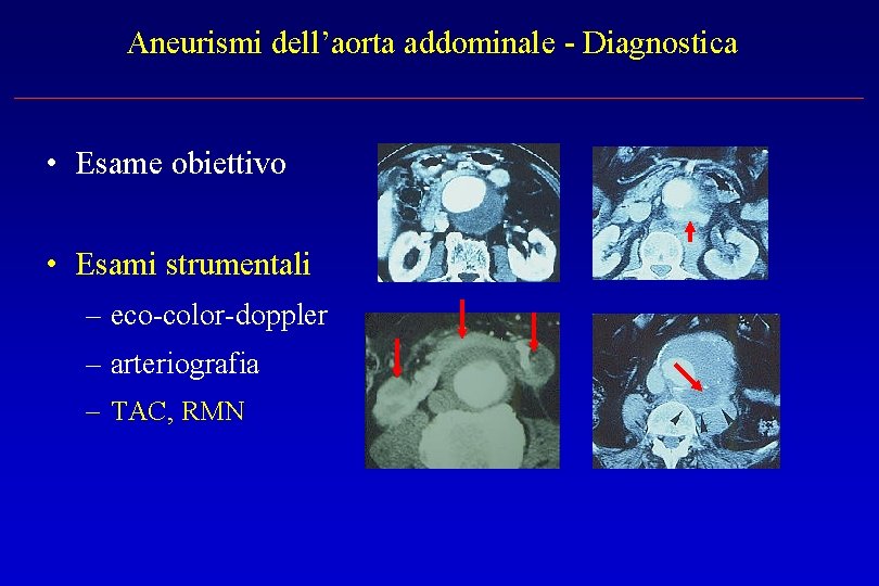 Aneurismi dell’aorta addominale - Diagnostica • Esame obiettivo • Esami strumentali – eco-color-doppler –