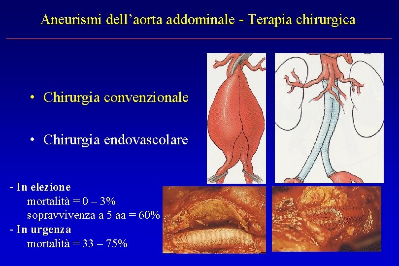 Aneurismi dell’aorta addominale - Terapia chirurgica • Chirurgia convenzionale • Chirurgia endovascolare - In