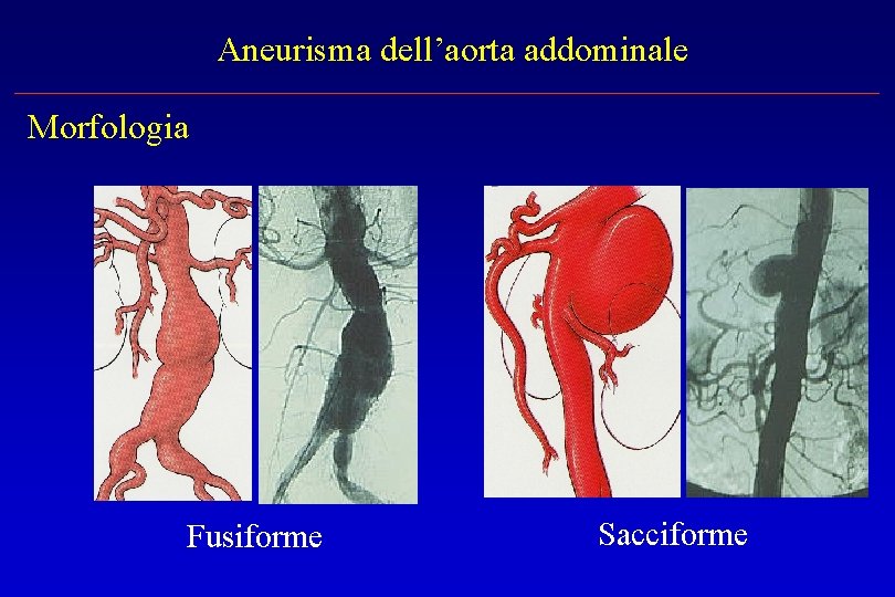 Aneurisma dell’aorta addominale Morfologia Fusiforme Sacciforme 