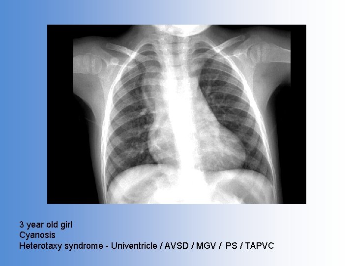3 year old girl Cyanosis Heterotaxy syndrome - Univentricle / AVSD / MGV /