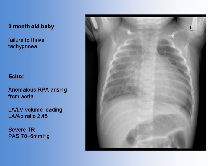 3 month old baby failure to thrive tachypnoea Echo: Anomalous RPA arising from aorta