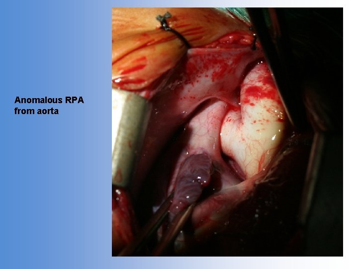Anomalous RPA from aorta 