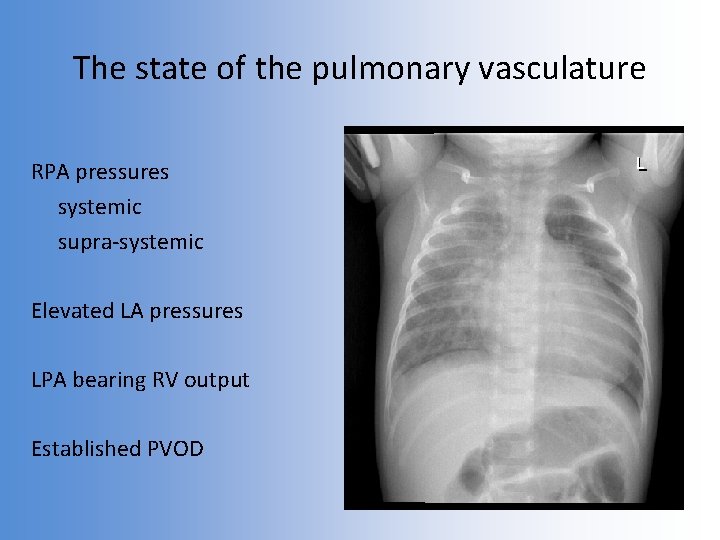 The state of the pulmonary vasculature RPA pressures systemic supra-systemic Elevated LA pressures LPA