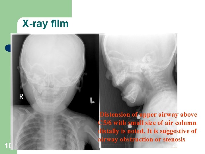 X-ray film 10 Distension of upper airway above C 5/6 with small size of