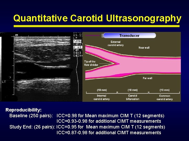 Quantitative Carotid Ultrasonography Reproducibility: Baseline (250 pairs): ICC=0. 98 for Mean maximum CIM T Quantitative Carotid Ultrasonography Reproducibility: Baseline (250 pairs): ICC=0. 98 for Mean maximum CIM T