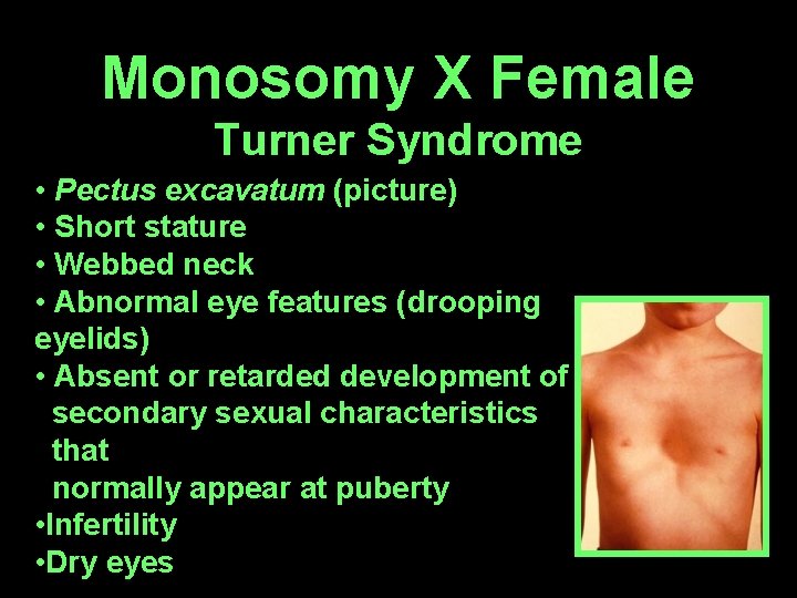 Monosomy X Female Turner Syndrome • Pectus excavatum (picture) • Short stature • Webbed