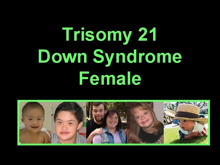 Trisomy 21 Down Syndrome Female 