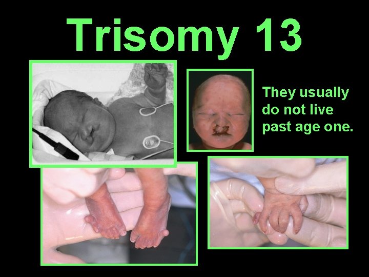 Trisomy 13 They usually do not live past age one. 