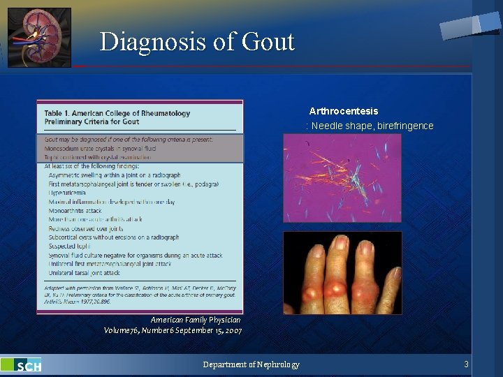 Diagnosis of Gout Arthrocentesis : Needle shape, birefringence American Family Physician Volume 76, Number