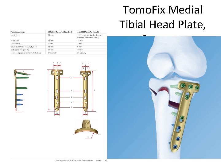 Tomo. Fix Medial Tibial Head Plate, Germany 