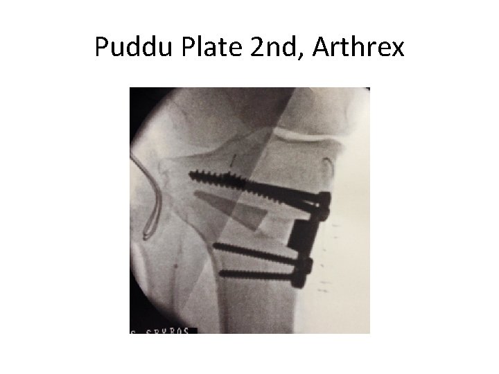 Puddu Plate 2 nd, Arthrex 