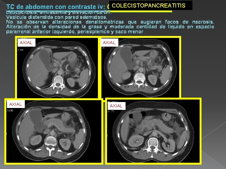 COLECISTOPANCREATITIS TC de abdomen contraste iv: Colecistopancreatitis. Leucocitosis, amilasemia y elevación de BT. Vesícula