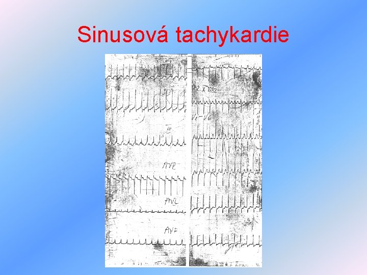 Sinusová tachykardie 