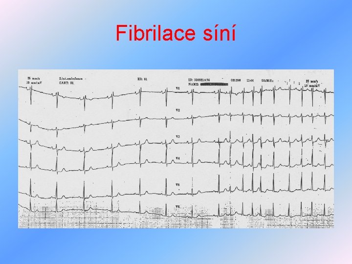 Fibrilace síní 