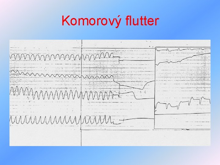 Komorový flutter 