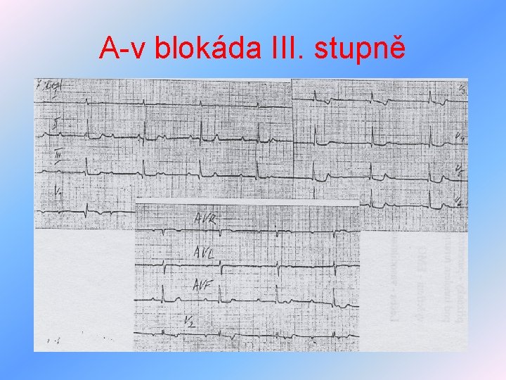 A-v blokáda III. stupně 