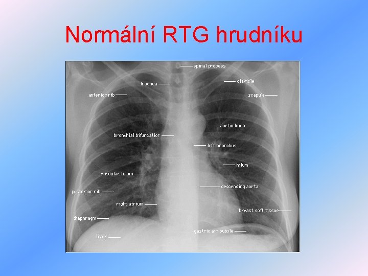 Normální RTG hrudníku 