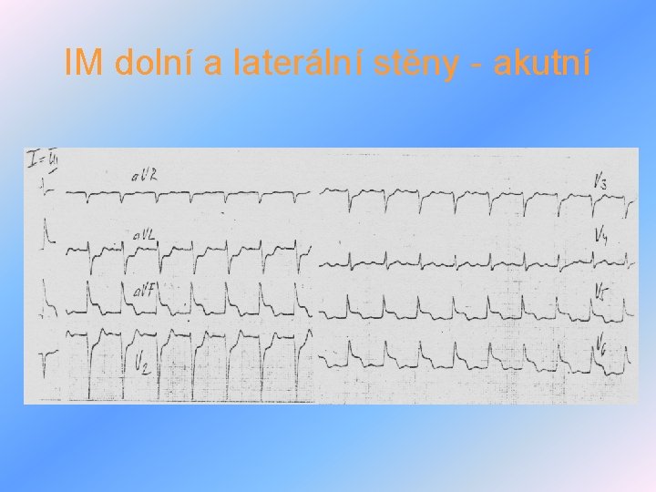 IM dolní a laterální stěny - akutní 