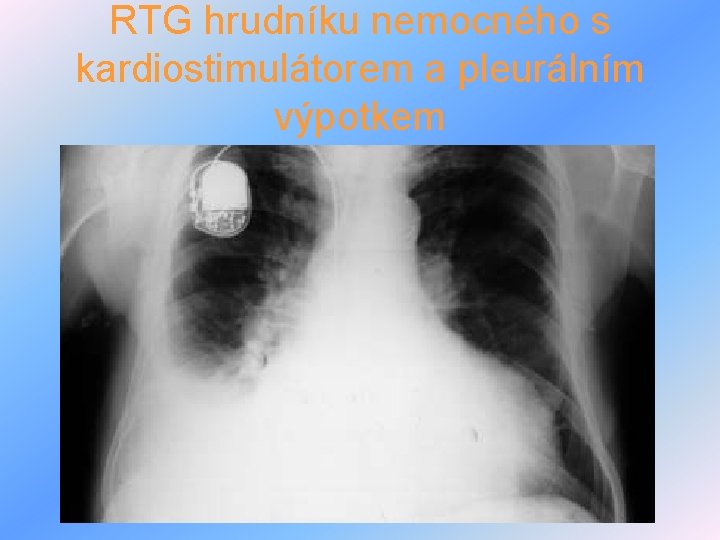 RTG hrudníku nemocného s kardiostimulátorem a pleurálním výpotkem 