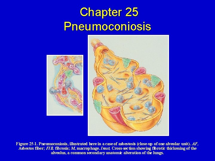 Chapter 25 Pneumoconiosis Figure 25 -1. Pneumoconiosis, illustrated here in a case of asbestosis