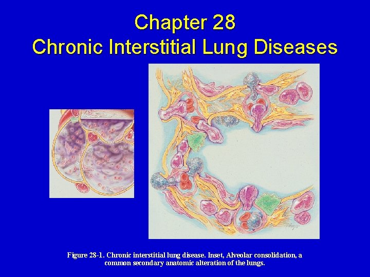 Chapter 28 Chronic Interstitial Lung Diseases Figure 28 -1. Chronic interstitial lung disease. Inset,