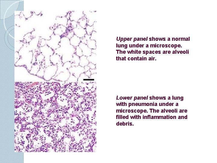 Upper panel shows a normal lung under a microscope. The white spaces are alveoli